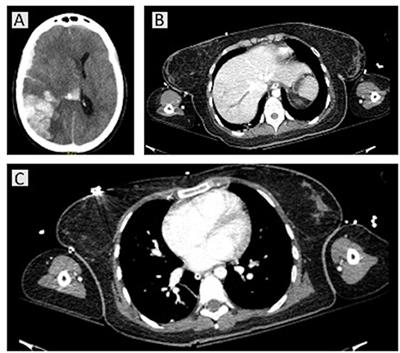 Patients With Suspected Severe Adverse Reactions to COVID-19 Vaccination Admitted to Intensive Care Unit: A Case Report